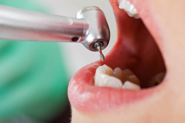 Best Broken or Chipped Tooth Repair in La Habra Heights, CA